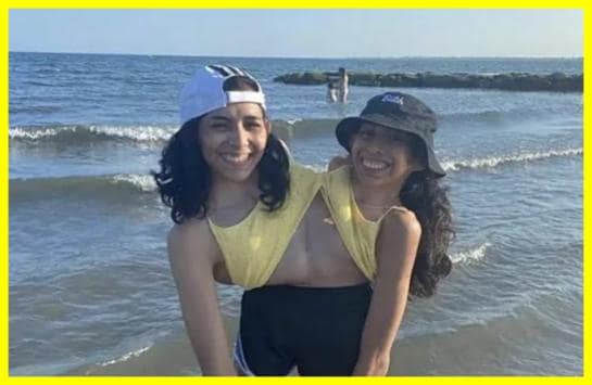 One of the conjoined twins, Carmen Andrade, has married